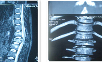 頸、胸、腰椎手術(shù)治療